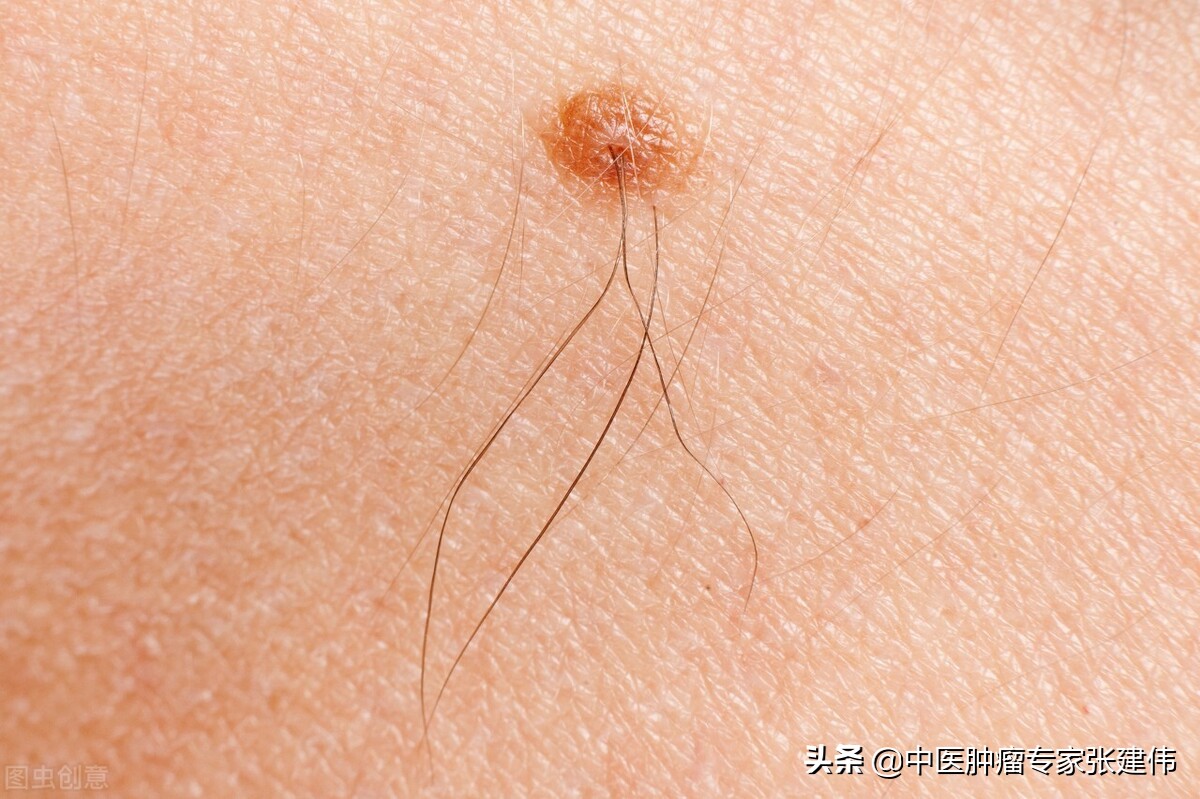 肉痣是怎么形成的容易癌变的痣,平痣易癌变还是凸起的痣易癌变