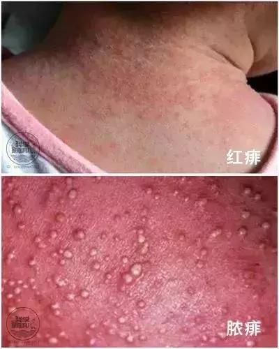 6种儿童常见皮肤病的鉴别指导,孩子容易出现的皮肤病你了解多少