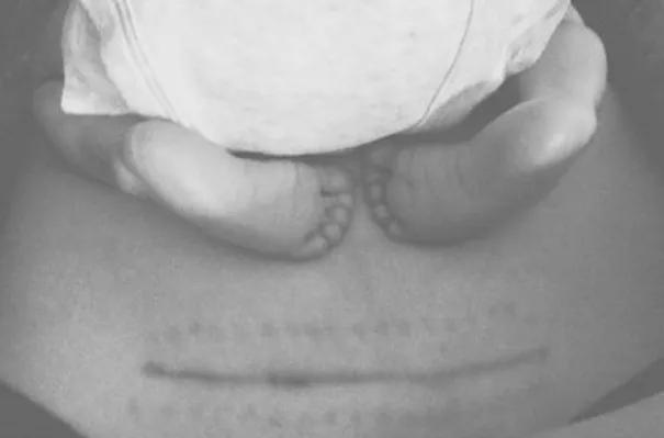 辟谣头胎是剖腹产二胎也必须剖吗,辟谣无痛分娩对胎儿影响大