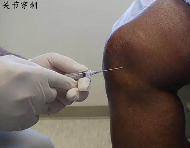 滑膜炎膝盖积水怎么治疗好得快,滑膜炎积水关节变形什么方法治疗