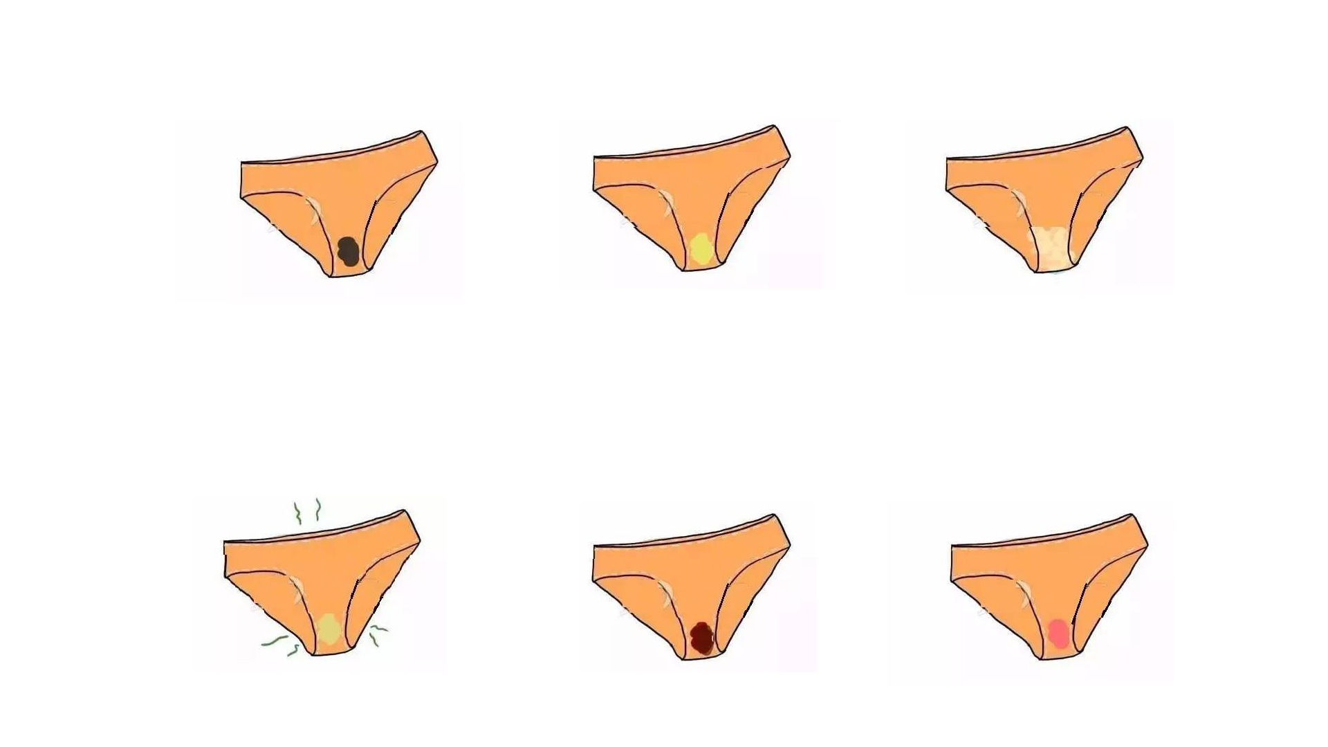 异味瘙痒白带泛黄是哪种妇科病,妇科瘙痒有异味白带多怎么办