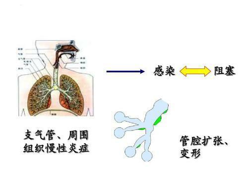 右肺上叶支气管扩张痰液引流体位,支气管扩张怎么正确体位引流