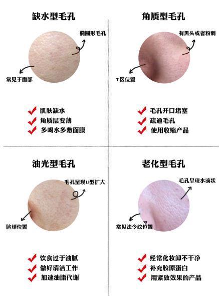 改善毛孔粗大黑头用什么面膜,干皮毛孔粗大黑头涂什么改善