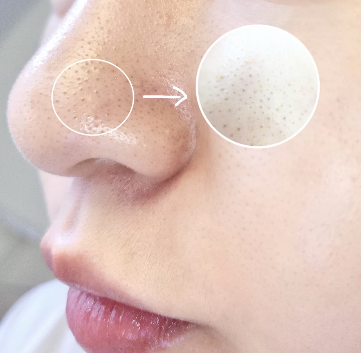 去黑头的几大“雷品”！城野医生用处不大，黑炭硬撕你敢用？