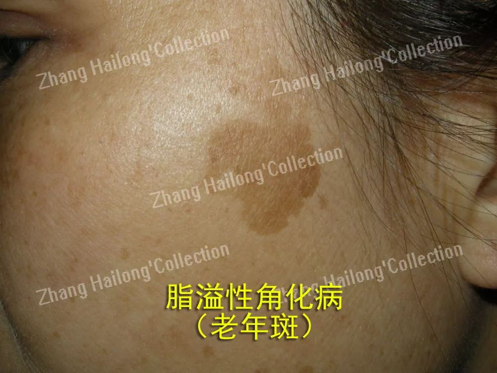 Ohno！老妈脸上出现了老年斑...