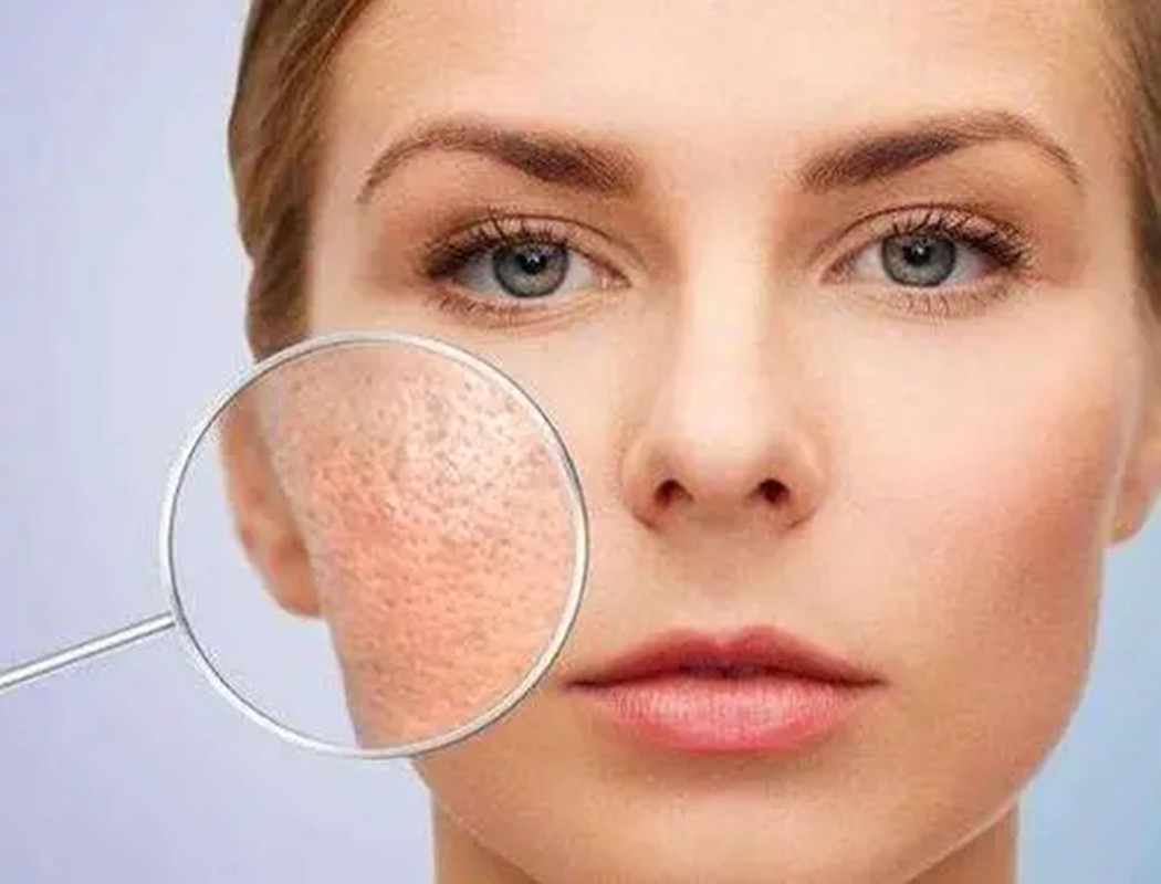 背部毛孔粗大像个马蜂窝,毛孔粗大修复日常