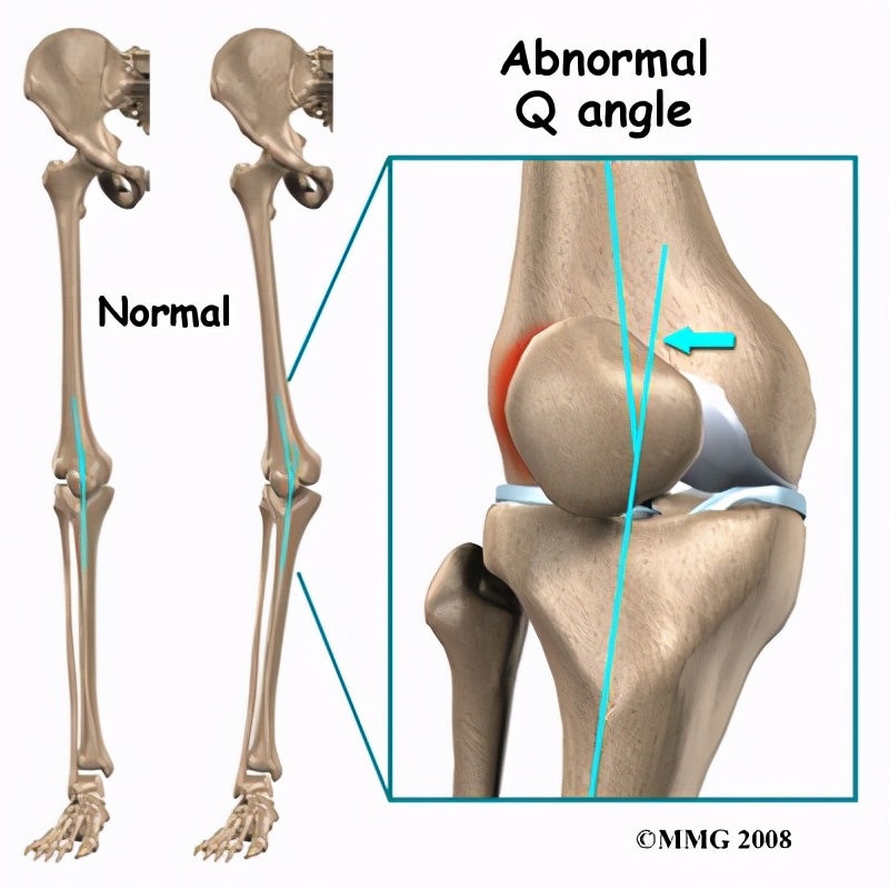 膝前疼痛如何治疗,髌骨软化症的症状与保守治疗方法