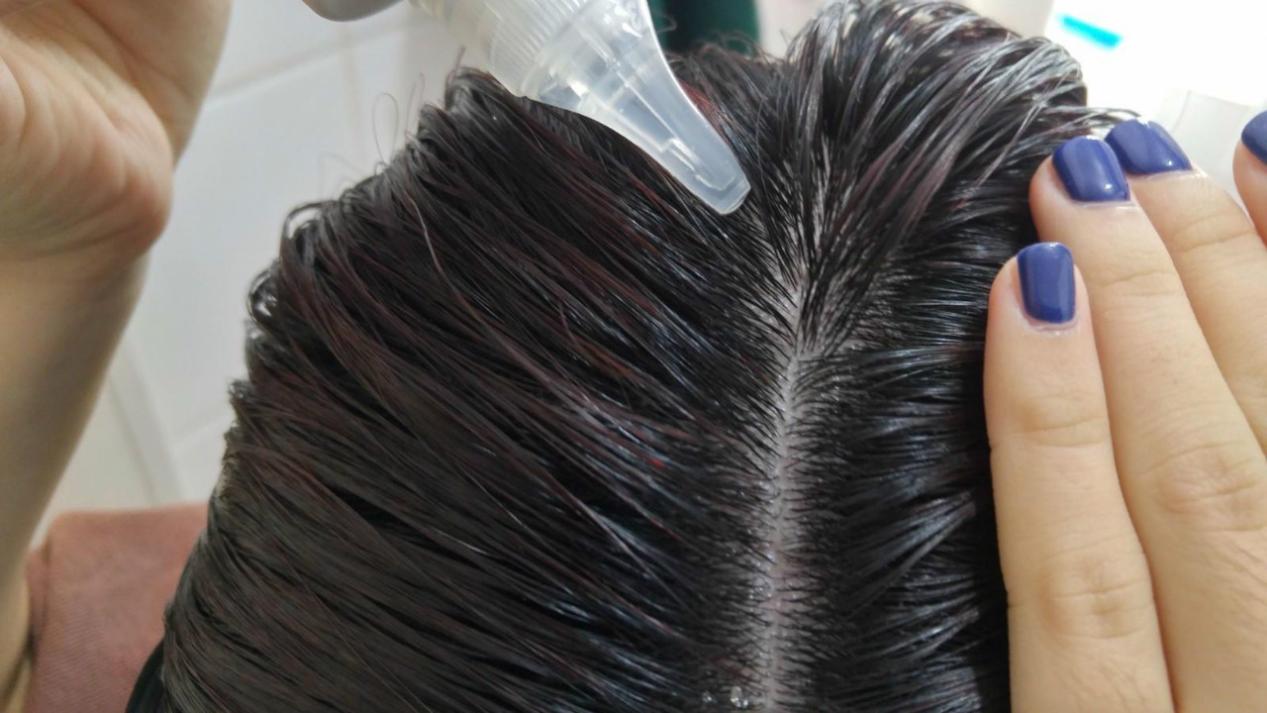 头皮屑反反复复的怎么治疗,头皮屑反反复复是什么原因导致的