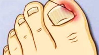 甲沟炎拔过指甲后怎么预防,脚趾盖掉了如何预防甲沟炎