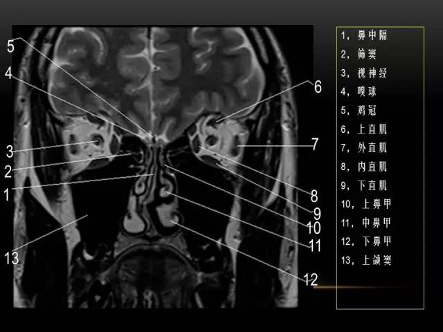 鼻腔鼻窦及颅底ct影像解剖,鼻窦解剖mri