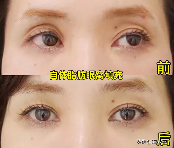 西京医院整形美容科面部年轻化,面部美容年轻化手术科普