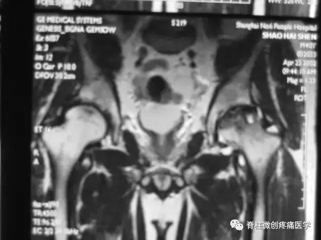 早期股骨头坏死核磁共振怎么看,股骨头坏死磁共振表现及分期