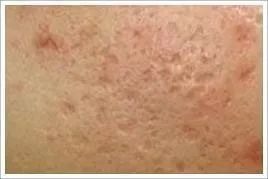 如何祛除痘印最有效的几招,教你几种有效去除痘印的方法