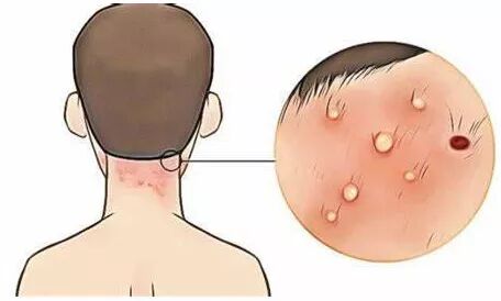 毛囊炎长粉刺和红色疙瘩怎么治疗,白头的红疙瘩是毛囊炎吗