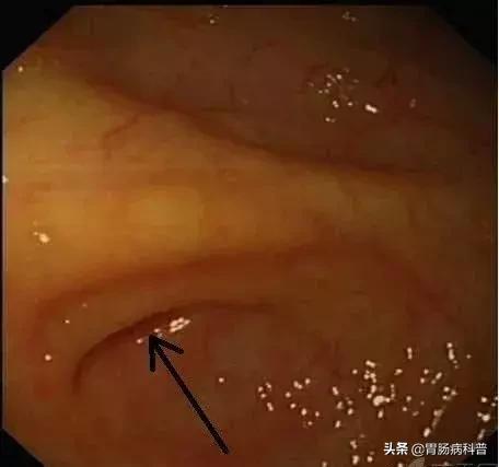 阑尾炎最新内镜微创手术,内镜下阑尾炎治疗术哪里可以做