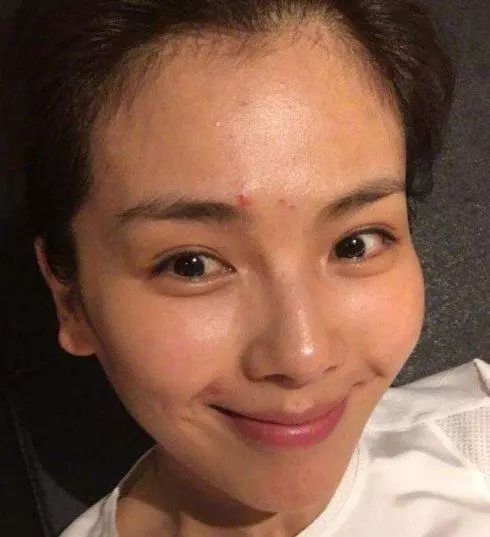 女星熬夜脸部痤疮,痘痘比较多的女明星