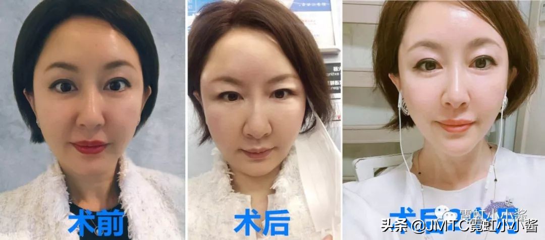 记录翻译小姐姐日本打溶脂针，肉脸变骨感脸全过程｜日本医美