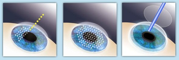 激光治疗近视眼手术十大危害,近视眼激光手术有什么风险和危害