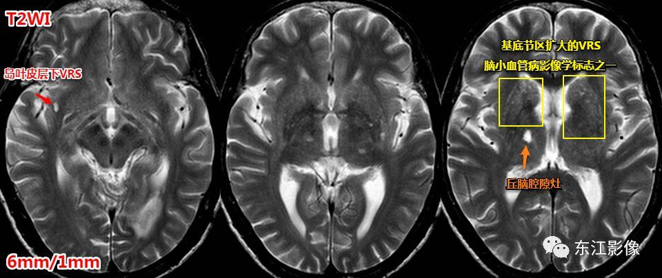 头颅mri扫描影像哪里找,头颅影像mra详细解说