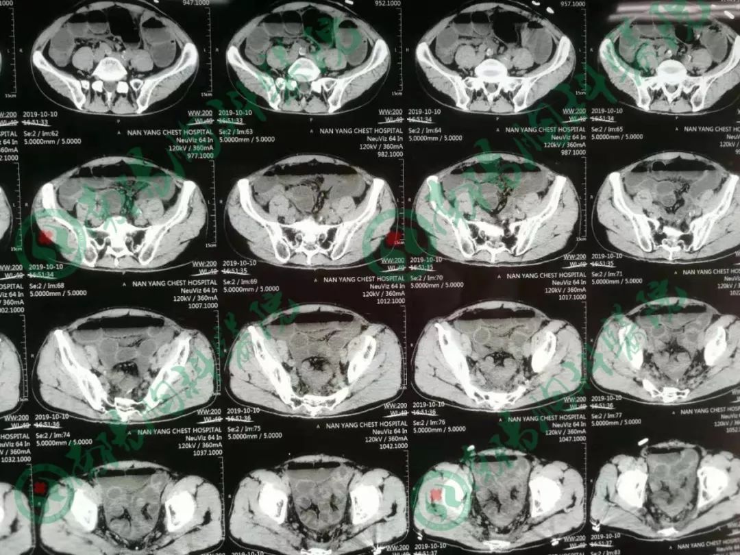南阳市胸科医院,乌鲁木齐肿瘤医院治直肠癌