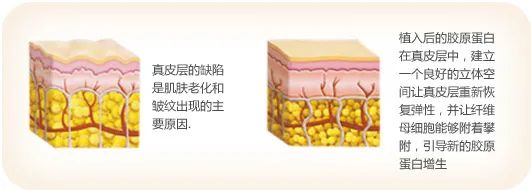 双美胶原蛋白治黑眼圈,双美胶原对血管型黑眼圈有用吗