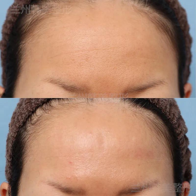 皱纹形成的小视频,皮肤松弛形成皱纹