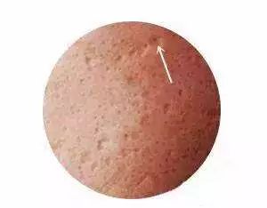 痘痘不可怕泛红才可怕,痘痘不是非常严重要不要管