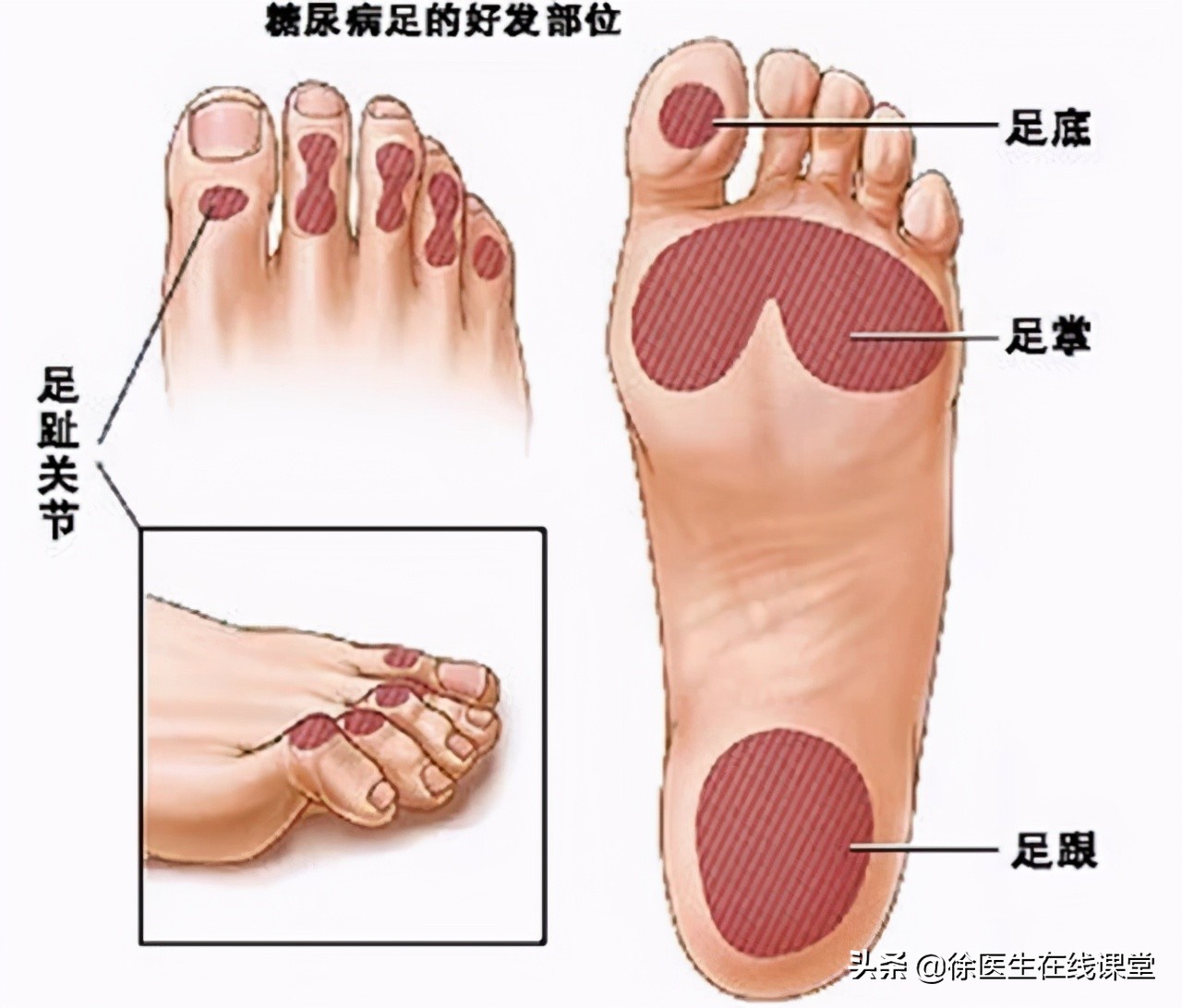 老年人脚底板疼怎么回事,老年人脚底板痛怎么回事怎么治