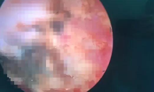 小女孩*体下**塞入异物流血不止！隔了几天走路都不对劲了