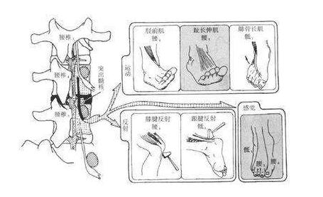 腰椎间盘突出脚肌肉萎缩怎么恢复,腰椎间盘突出会导致腿部肌肉萎缩