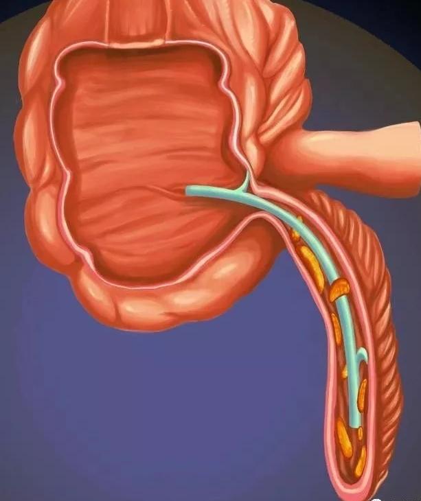 怎么让阑尾炎不复发,不开刀也能治愈阑尾炎