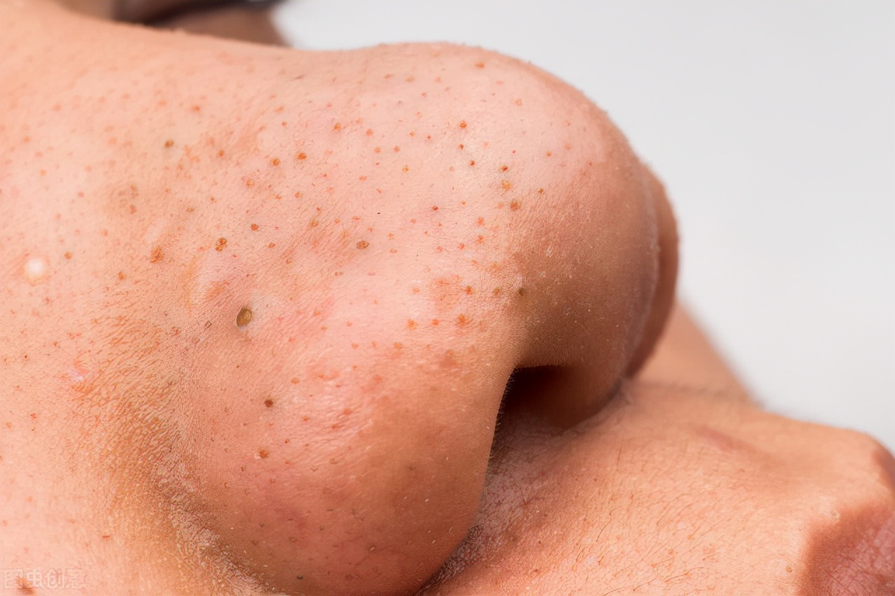 怎么去黑头又快又有效,怎么去黑头又简单又有效