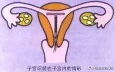 产后大姨妈没来就不用避孕？你还在信？是时候该反省下自己了