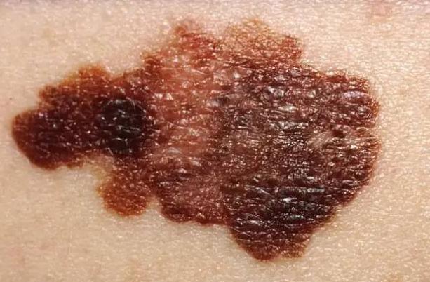 皮肤长出这种痣，十有八九是黑色素瘤！医生提醒：请及时切除