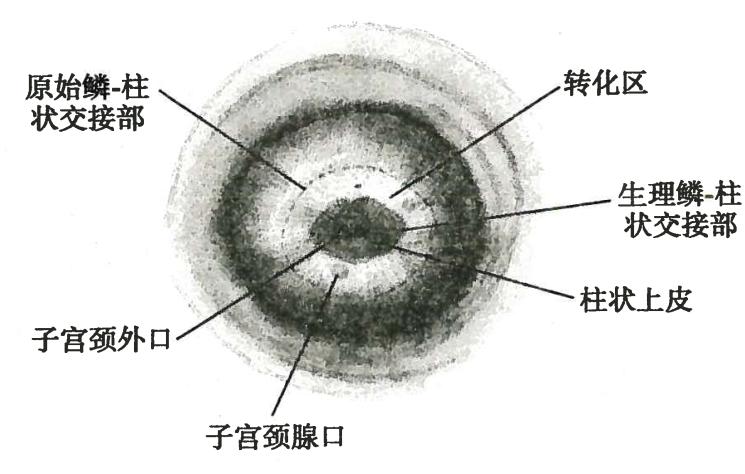 宫颈糜烂离宫颈癌还有多远呢？