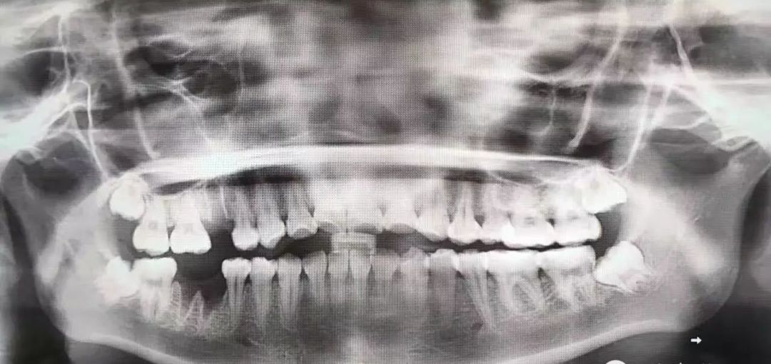 拔智齿是怎么算收费的,拔智齿是按智齿个数收费吗