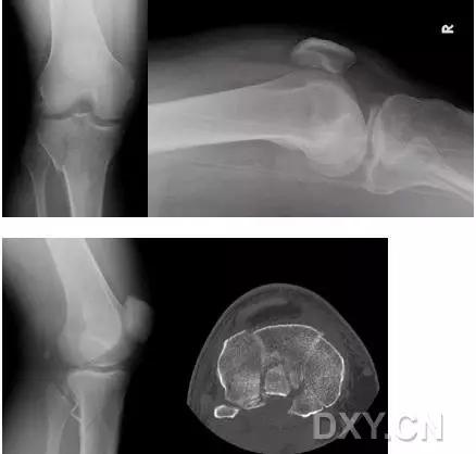 所有骨折都叫什么名字,骨折的名称有哪些