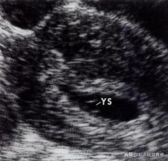 内见卵黄囊,卵黄囊肿瘤