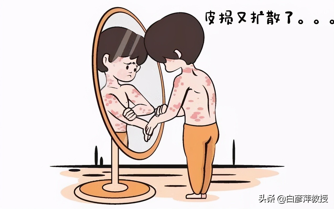 “难缠”的银屑病，能让“它”彻底“消失匿迹”吗？