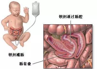 恐怖的肠套叠经历！抓住救命黄金12小时