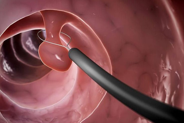 体外长息肉能自行解决吗,长息肉不动手术会得癌吗