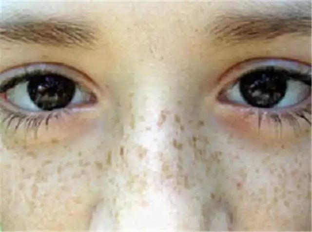 眨眼睛面部肌肉跟着动是什么原因,面部三叉神经痛是什么原因导致的