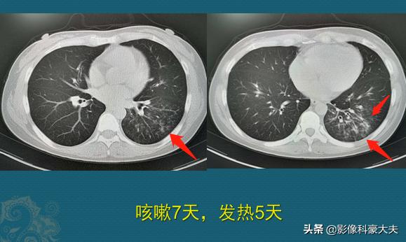 1场支原体肺炎，我拉黑了学理科的女同学