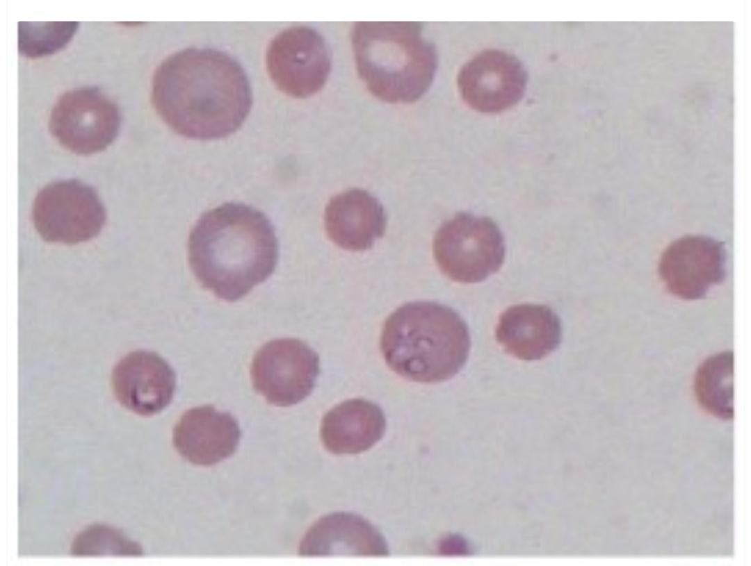 蜱虫感染巴贝斯,狗狗身上有蜱虫传染给人什么样的
