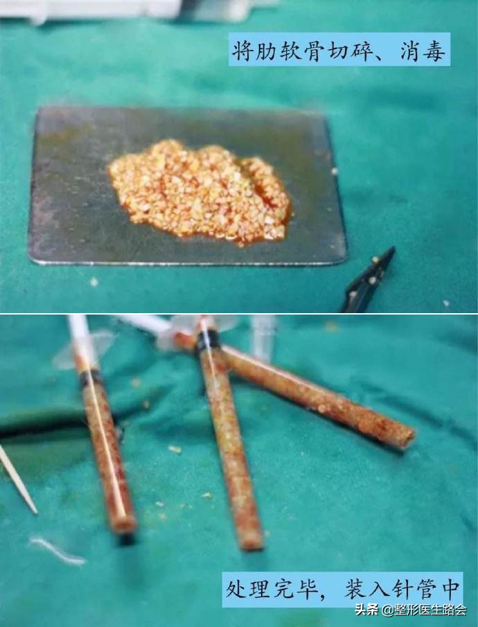 膨体垫鼻基底能管一辈子吗,膨体垫鼻基底要打钉子吗