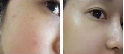 这辈子都不要去碰的四个医美项目,40岁后医美项目这样选