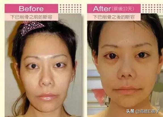 微整形需要多久,最受欢迎的5大微整形