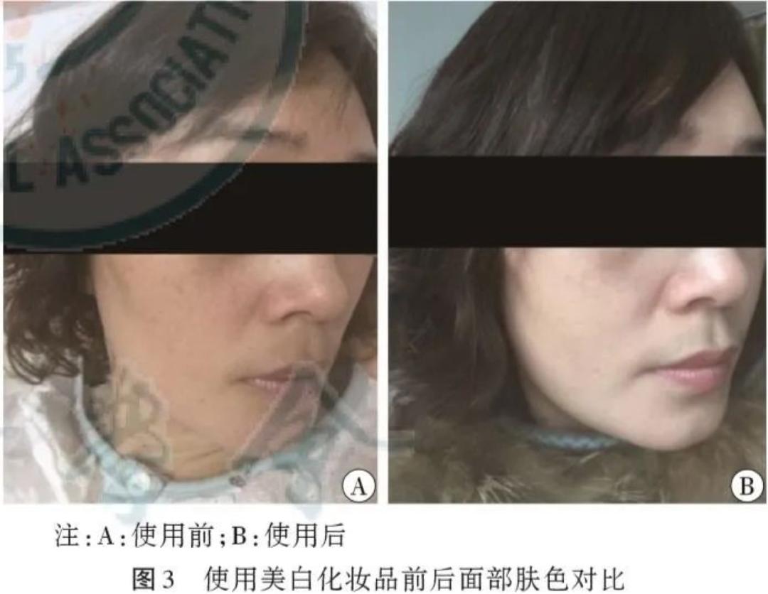 用了美白套餐，进了ICU！肾内科医生：最怕你用美白产品