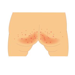 痔疮犯了有几种原因,痔疮按佛家说法是犯了什么罪