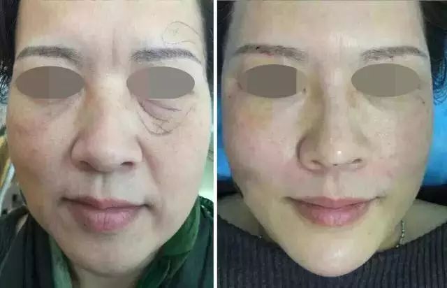 王祖贤到底有没有整容,王祖贤整容成功了吗